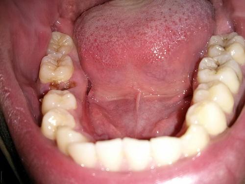 成人蛀牙清理视频